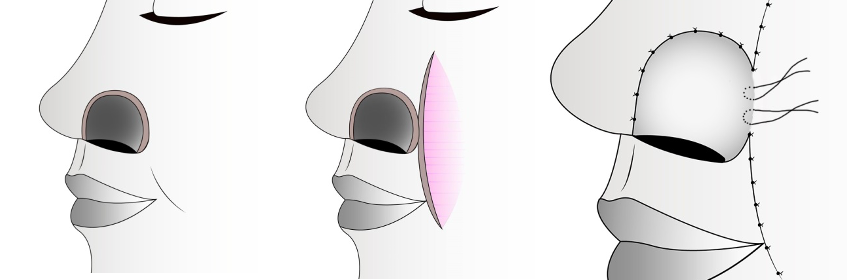Как проходит операция: поэтапно