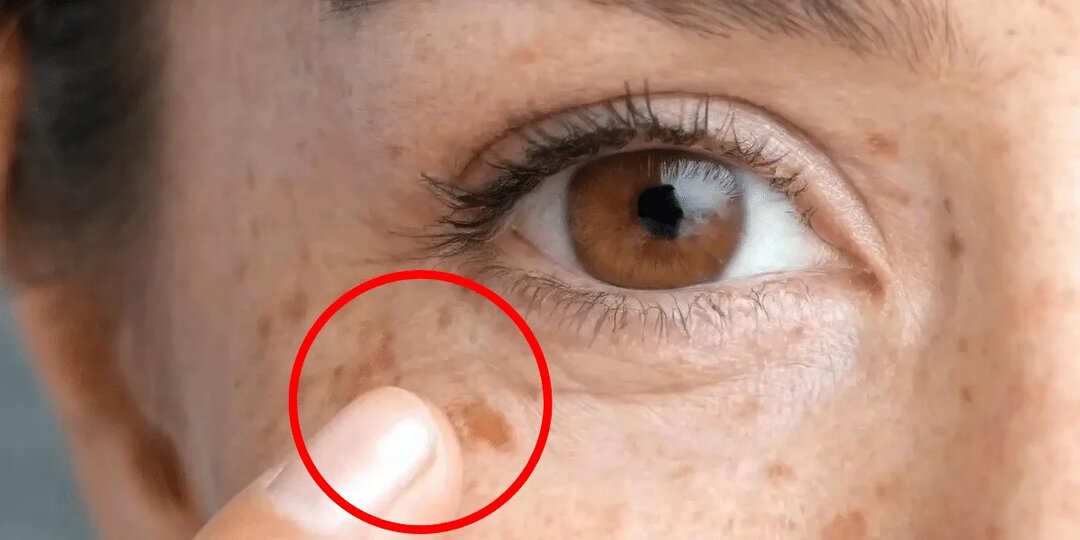 Пигментные пятна: не просто «возраст», а сигнал изнутри — как понять причину и что с этим делать