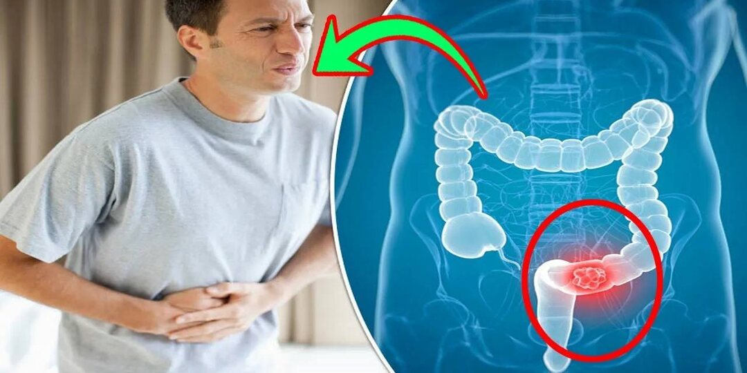 Рак кишечника: как распознать и какие факторы увеличивают риск?