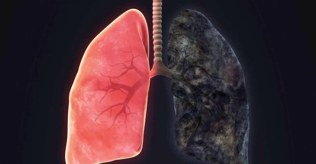 ХОБЛ: Почему эта болезнь может быть незаметной до поздних стадий?