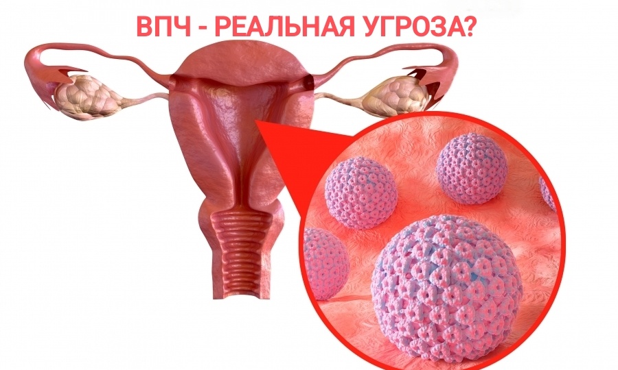 ВПЧ — вирус, о котором слышали все, но понимают немногие