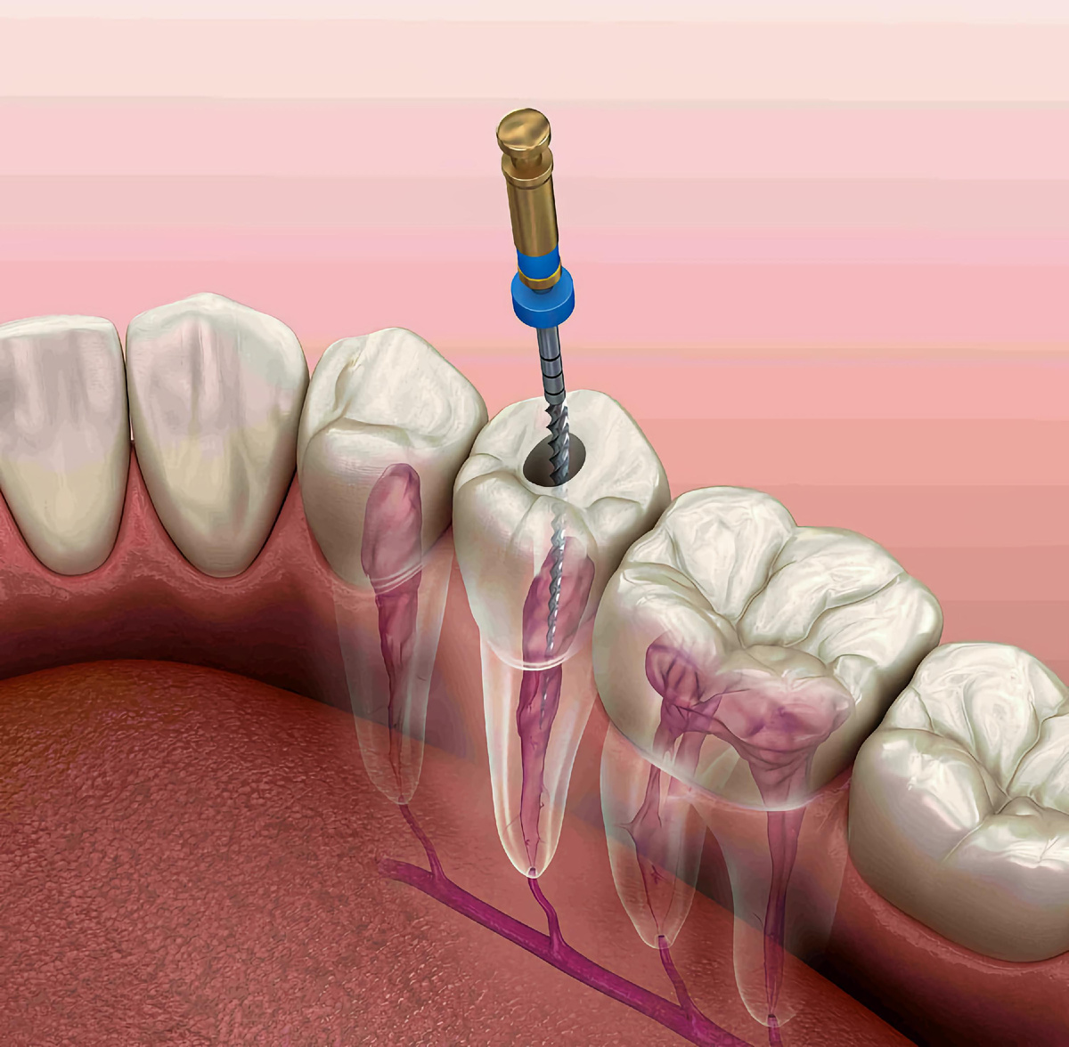 Удаление нерва зуба