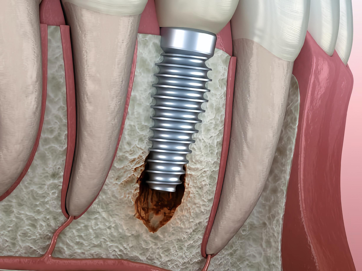 Срок службы импланта 