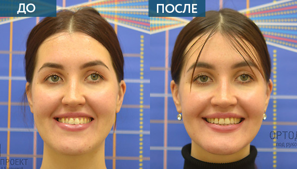 Неправильный прикус, внешность до и после лечения