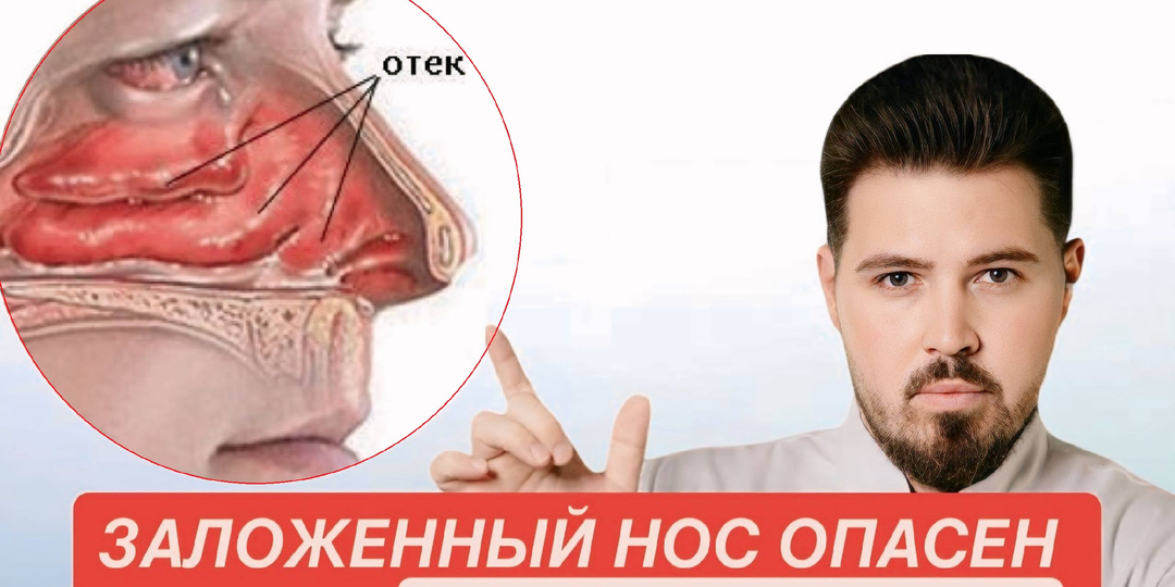 Как открыть заложенный нос за 5 минут: 2 простых упражнения, которые помогают даже при хронической заложенности