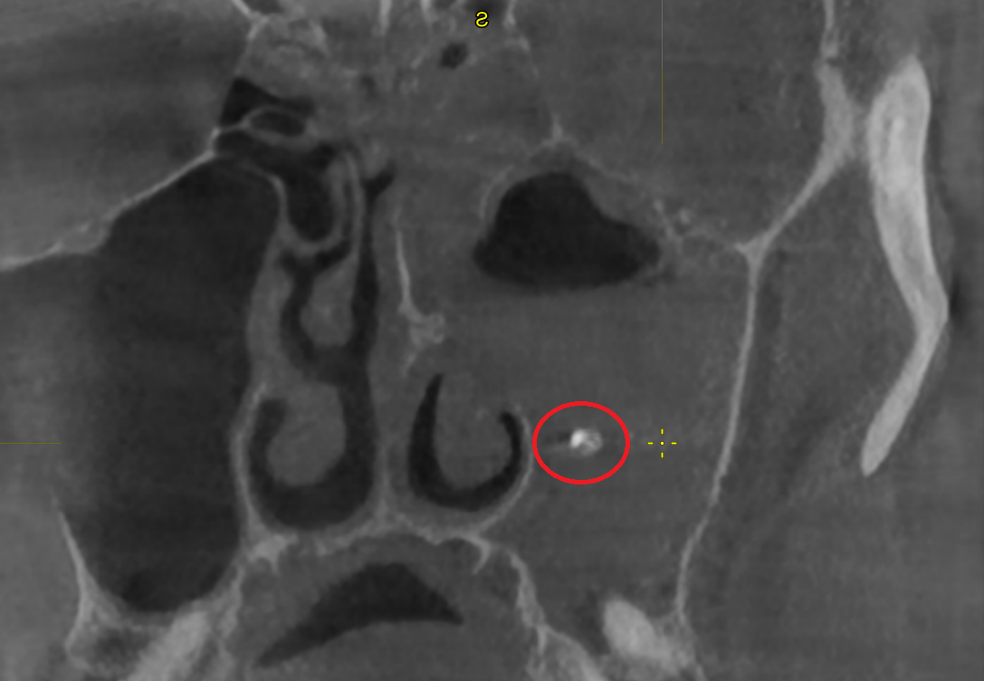 В красном кружочке - корень зуба, оказавшийся не на своём месте. Серое вокруг - воспаленная слизистая пазухи и гной.