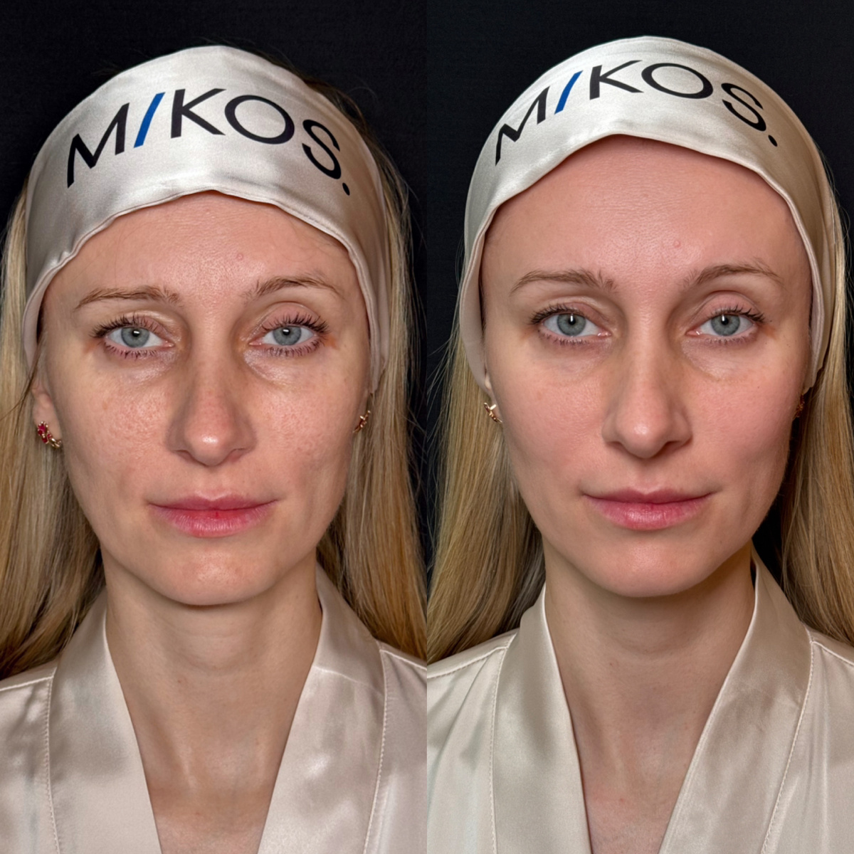 Результат процедуры Lumecca