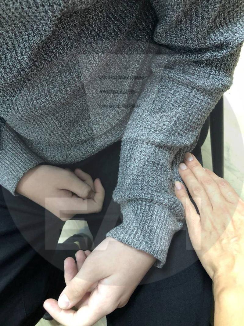    Даже на фото видно, что рука сломана в нескольких местах