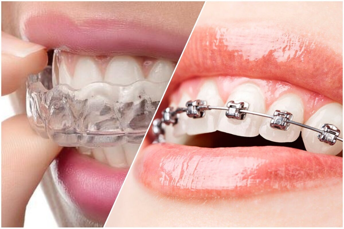 Брекеты и элайнеры