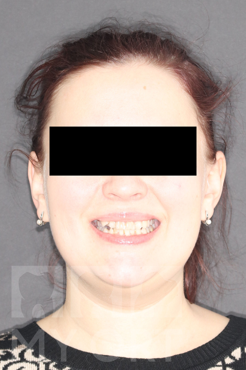 Улыбка пациентки до лечения ->