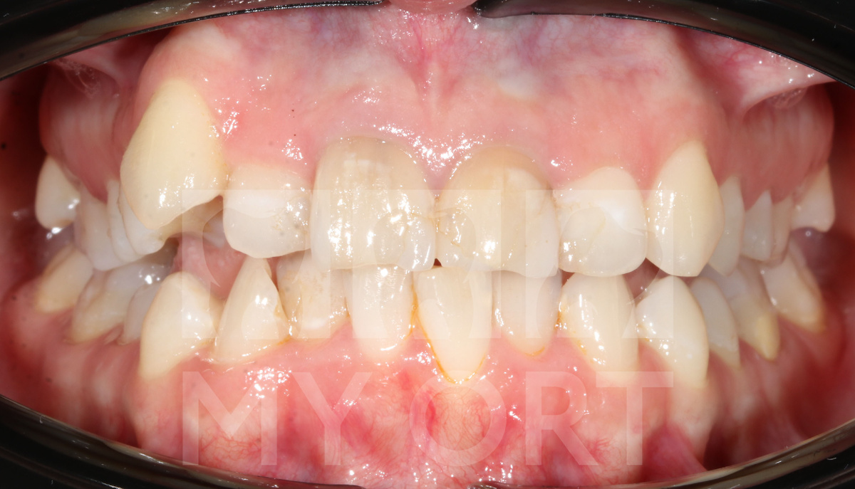 Значительная скученность зубов