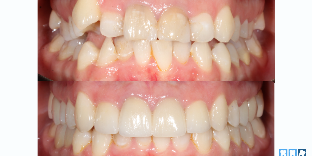 Пациентка с аллергией на металл: как мы провели ортодонтическое лечение без брекетов