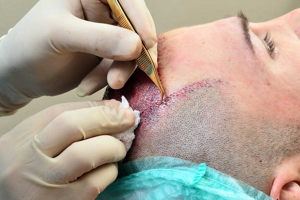 Пересадка волос в Москве 