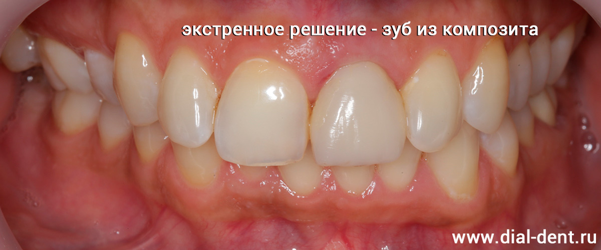 экстренное решение восстановления эстетики - композитный зуб