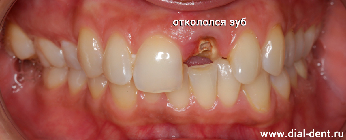 откололся передний зуб под основание