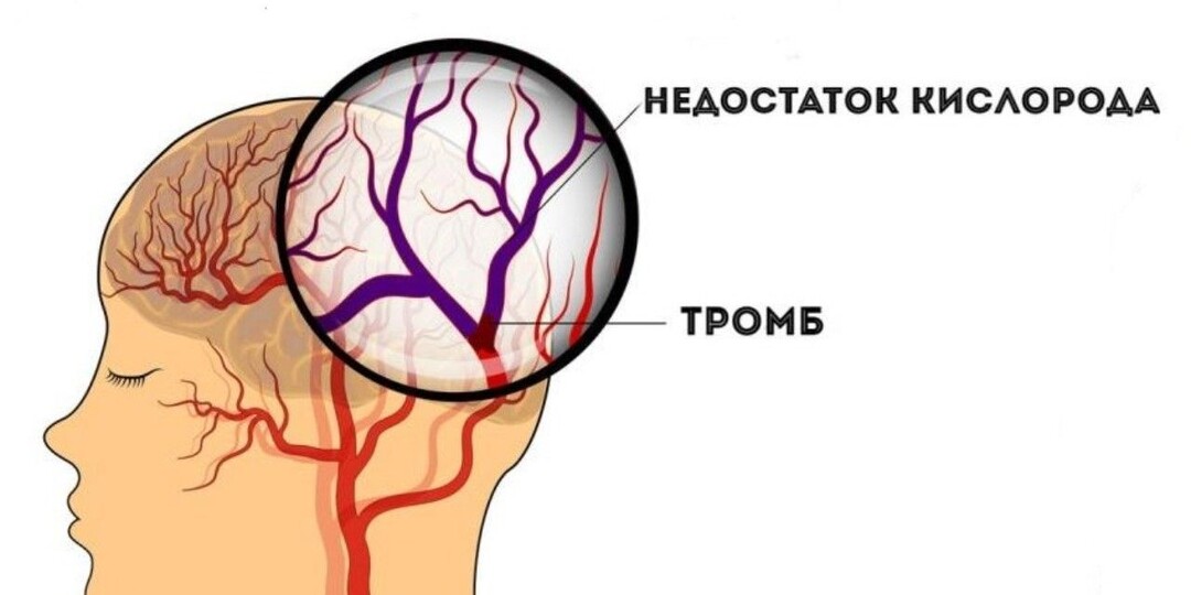 Кислорода не хватает мозгу: признаки, которые ведут к инсульту