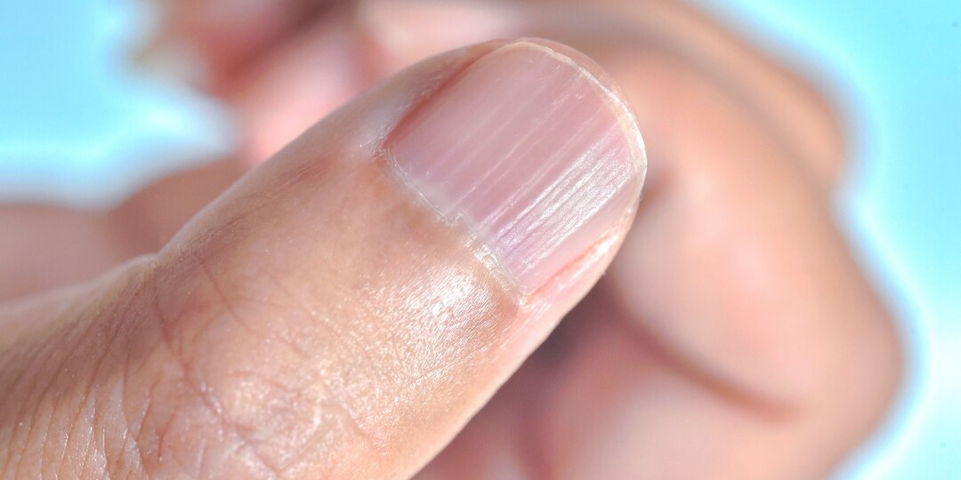 Ногти потускнели и стали ребристыми — это не возраст, а сигнал болезни