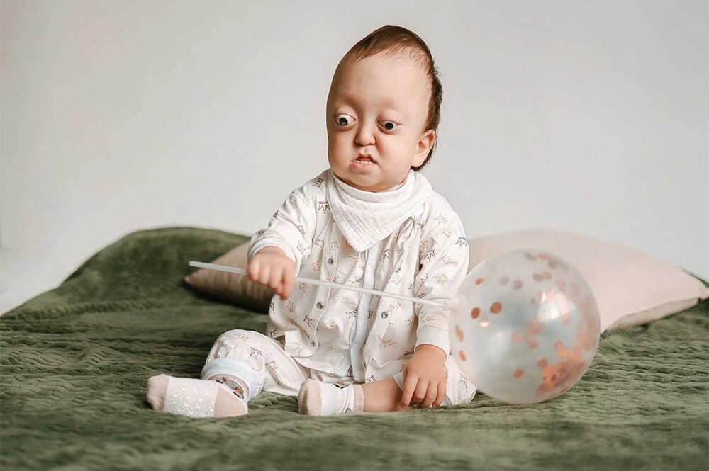    У малыша диагностировали синдром Крузона. Фото: Анна Лебедкина