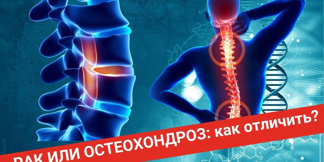 Боли, которые говорят об онкологии: многие списывают их на остеохондроз