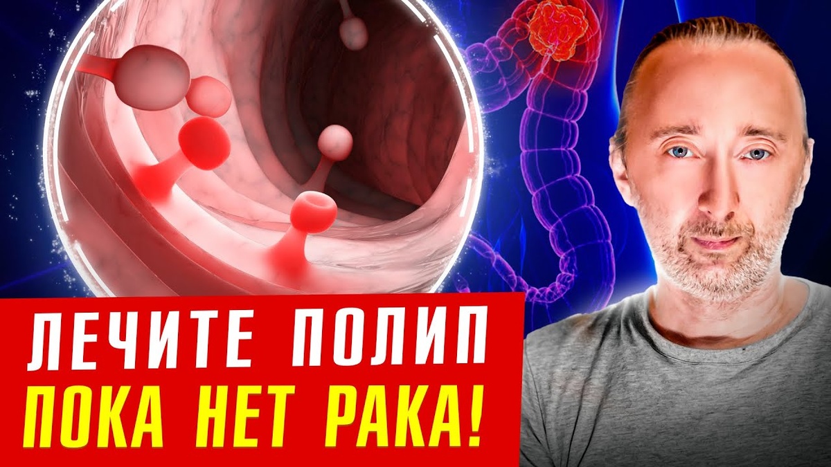 Пять ранних признаков полипов кишечника, которые могут привести к раку