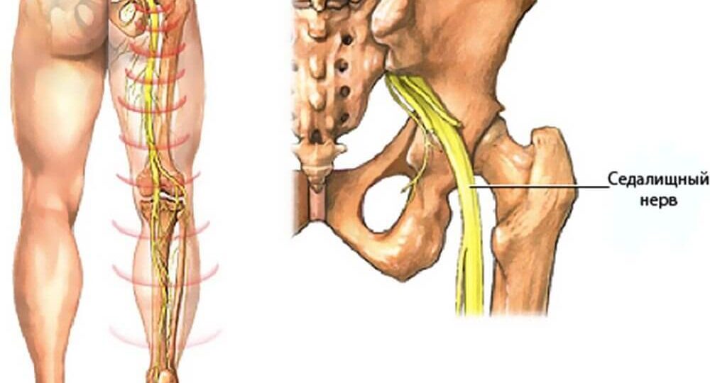 Седалищный нерв: как отличить истинное защемление от мышечной маскировки