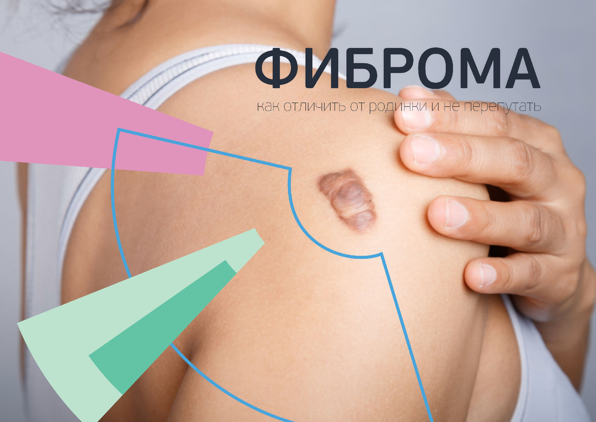 Фиброма или родинка? Как отличить самостоятельно и не перепутать