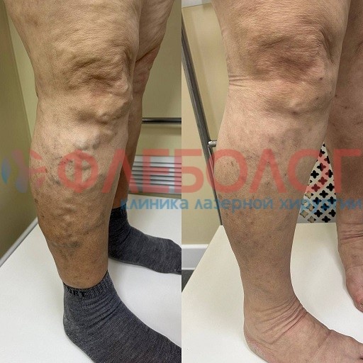 Фото работ До/после лазерного лечения