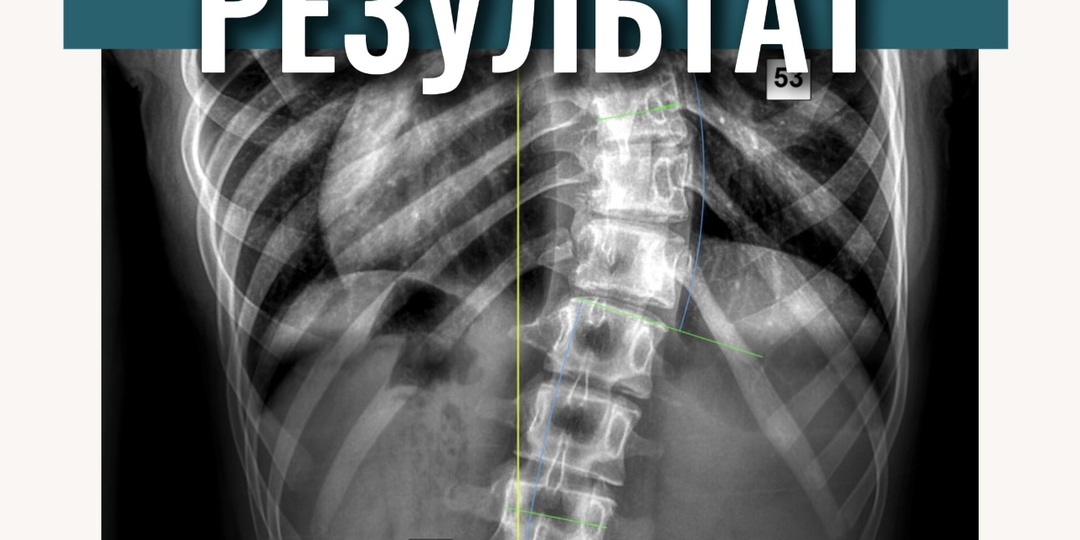Первый результат в корсете Шено