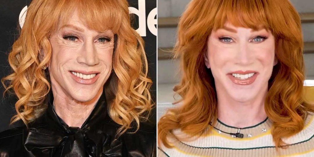 Кэти Гриффин показалась без макияжа после лифтинга шеи — фанаты шокированы. А хирурги? Улыбнулись.