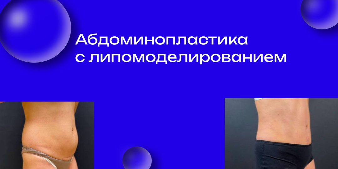 Абдоминопластика с липомоделированием