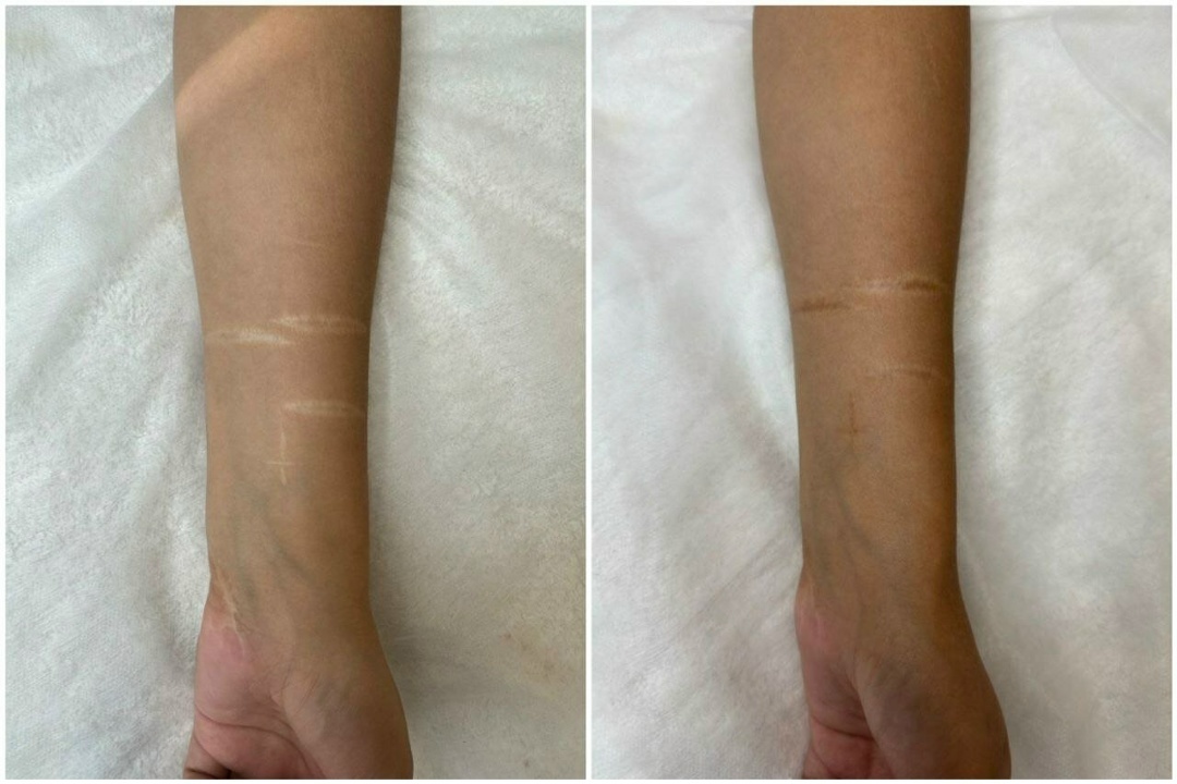 Перекрытие шрамов в мск 