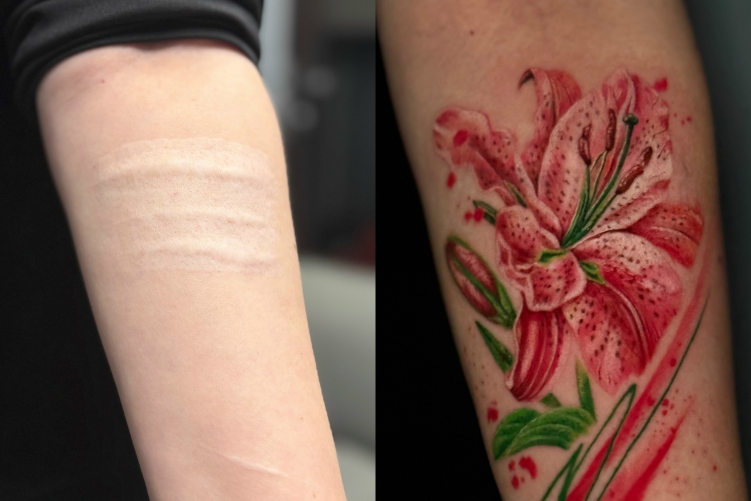 Перекрытие шрамов в Москве