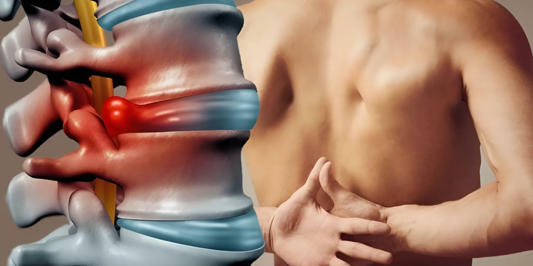 Грыжа в пояснице — не повод лежать: как сохранить активность и избежать операции