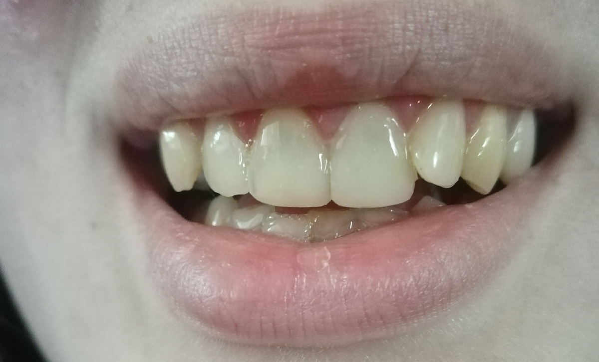 Мои зубы до всех манипуляций