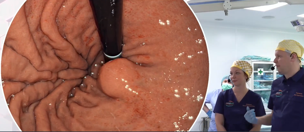 ЭГДС перед операцией: неэпителиальное новообразование кардиального отдела желудка