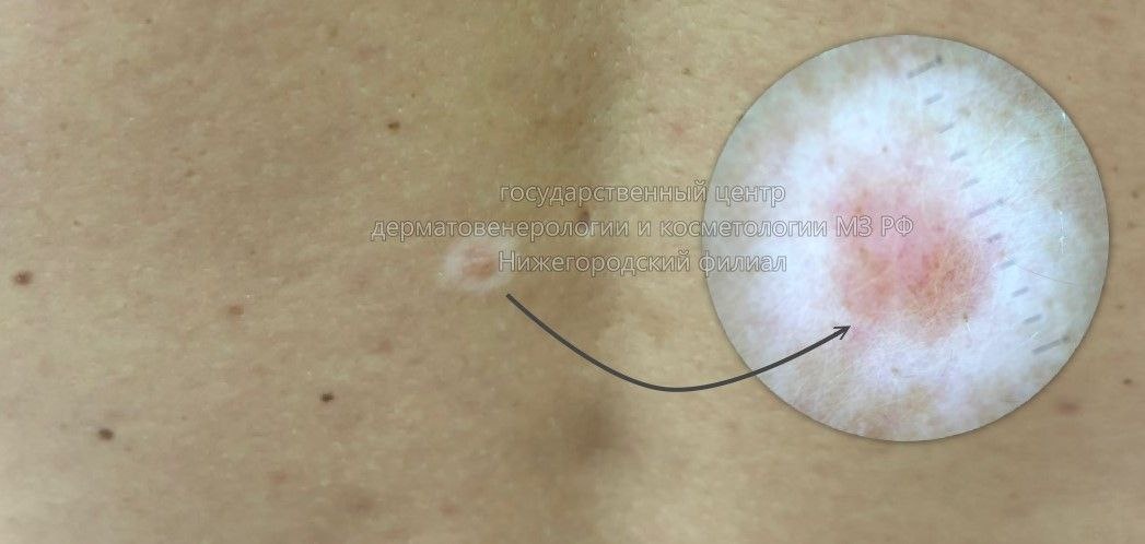    К появлению галоневуса может привести избыточный загар, солнечные ожоги и стресс