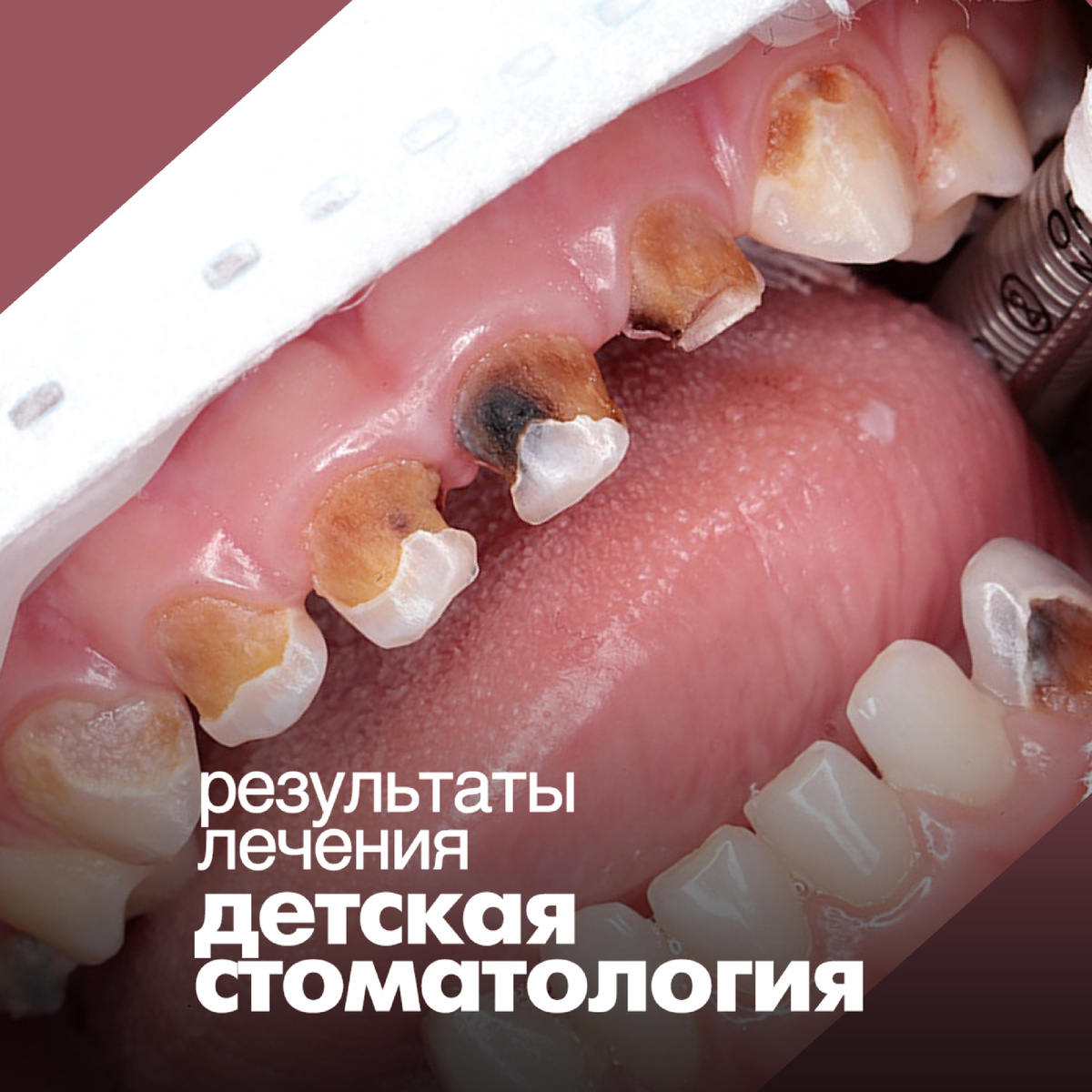 К моменту лечения 16 зубов нуждались в лечении.....