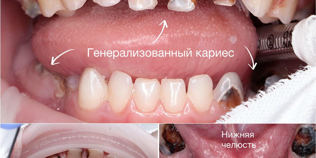 Генерализованный кариес у детей - это поправимо?