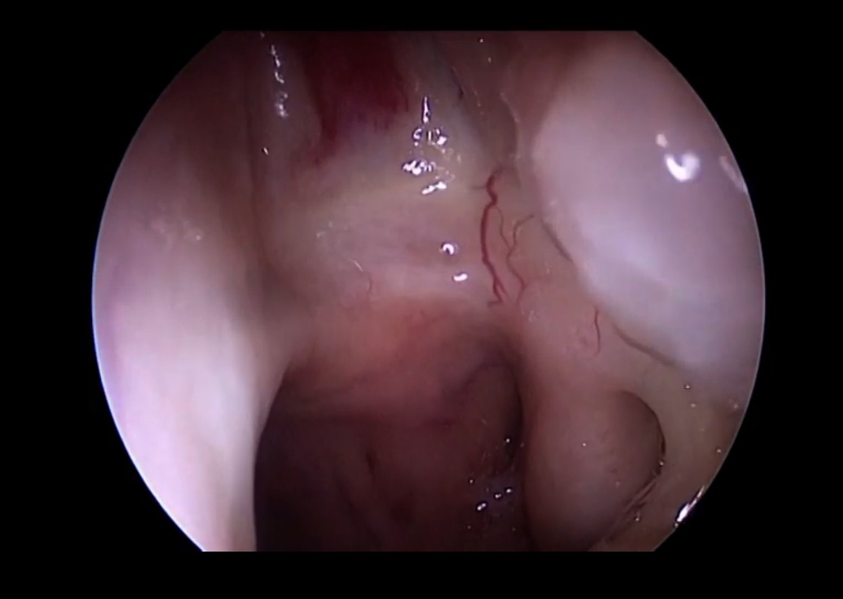 Здоровая слизистая носа