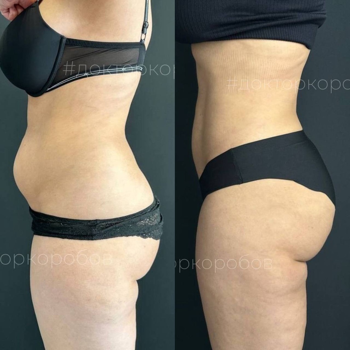 Липосакция живота с прорисовкой спортивных линий, липосакция пояснично-боковых областей и бедер; липофилинг ягодиц. Результат через год после операции.