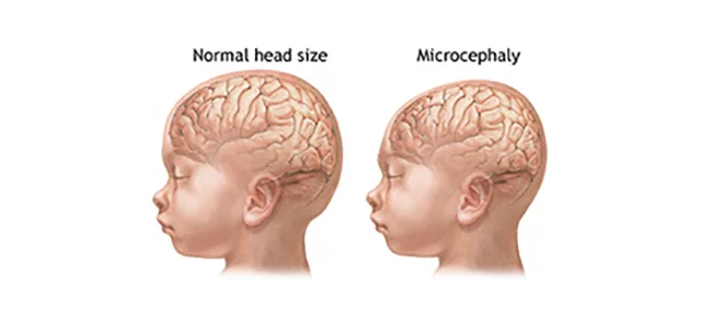 Ребенок с микроцефалией и без [https://www.dyrk1a.org/main-blog/microcephaly-a-main-feature]