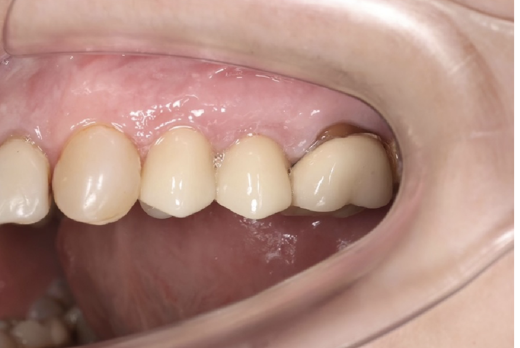 Зуб 2.6 под дефетной коронкой