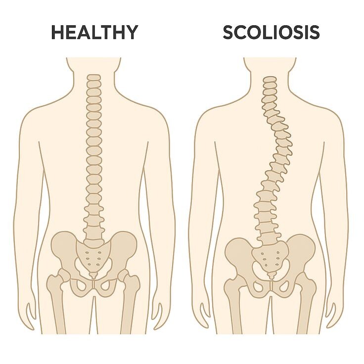 Правильная осанка и сколиоз