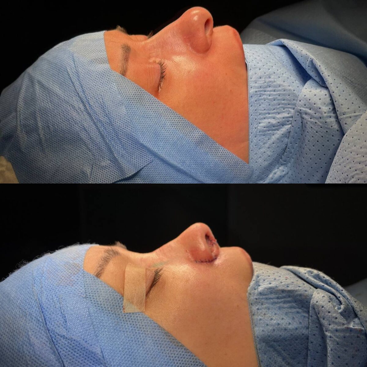 Ринопластика: результат сразу на операционном столе. Хирург к.м.н. Остринская Т.В.