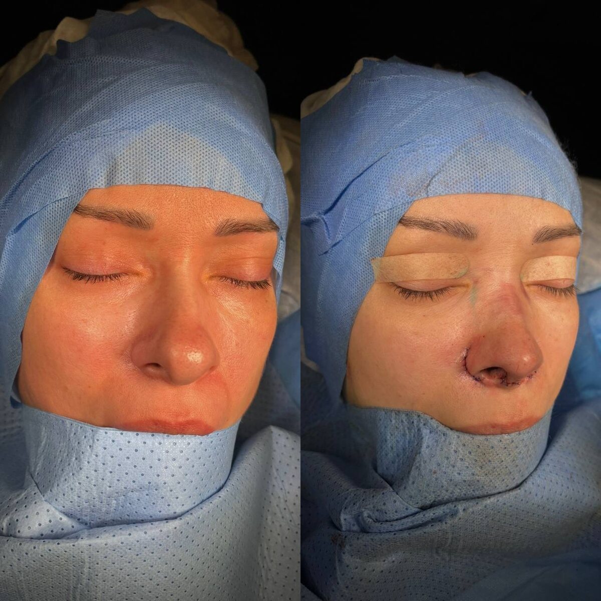 Ринопластика: результат сразу на операционном столе. Хирург к.м.н. Остринская Т.В.