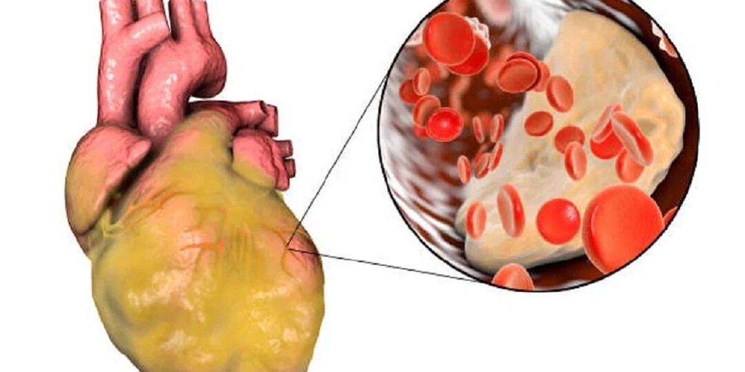 Сердце Работает «на Износ»: Опасные Сигналы, Которые Появляются за Год до Инфаркта — Кардиологи Называют 8 Признаков