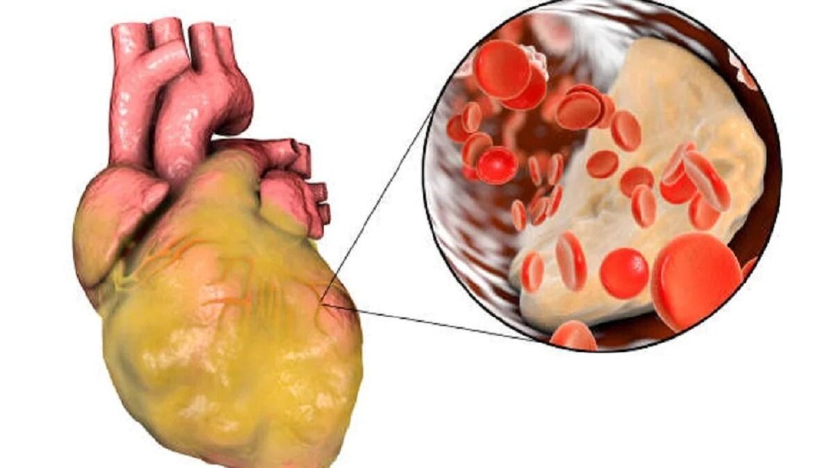 Сердце Работает «на Износ»: Опасные Сигналы, Которые Появляются за Год до Инфаркта — Кардиологи Называют 8 Признаков