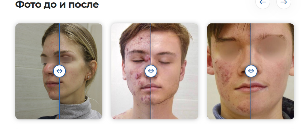 Хотите решить проблему акне навсегда? Переходите на наш сайт! 