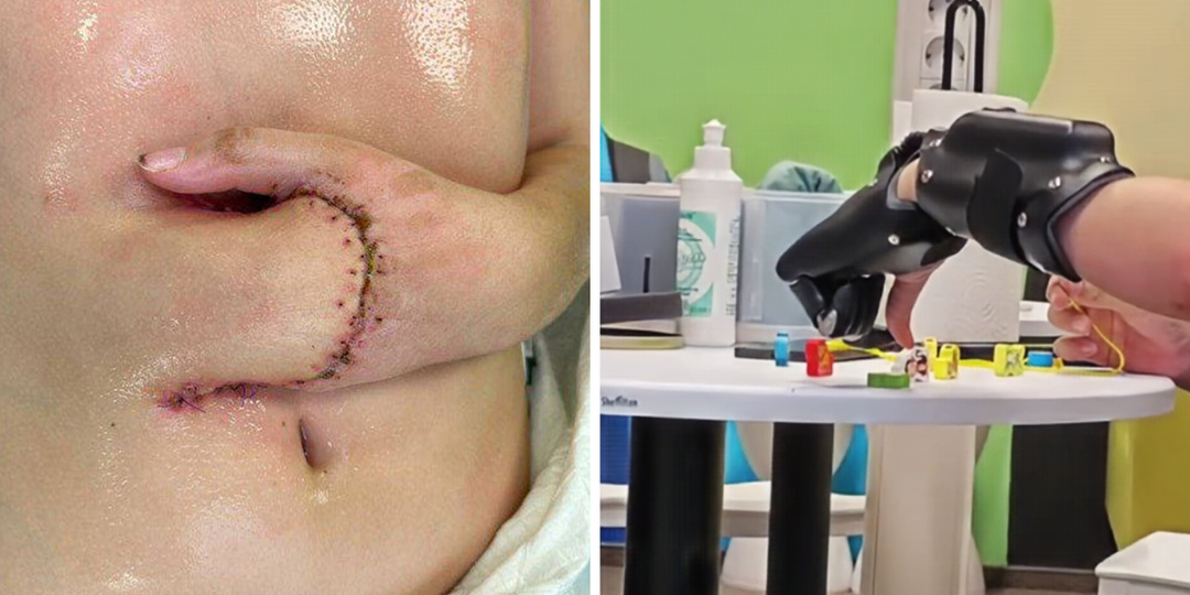 В Коммунарке спасли ребенка, пришив руку к животу