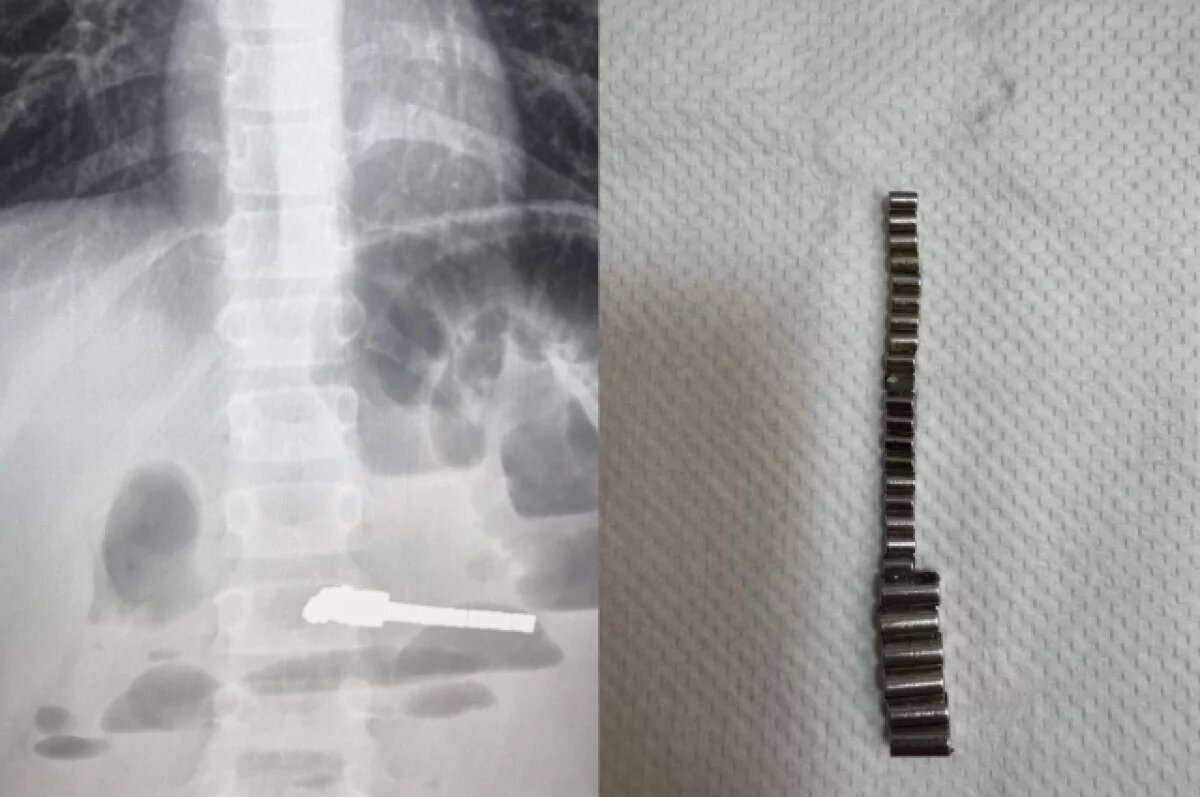    Хирурги в Новосибирске спасли ребёнка, проглотившего 25 магнитов